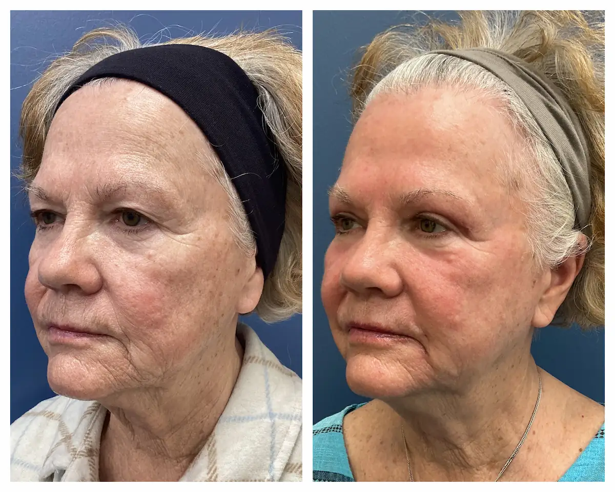 Full-face CO2 laser resurfacing before and after, oblique view — St. Louis Dermatology & Cosmetic Surgery