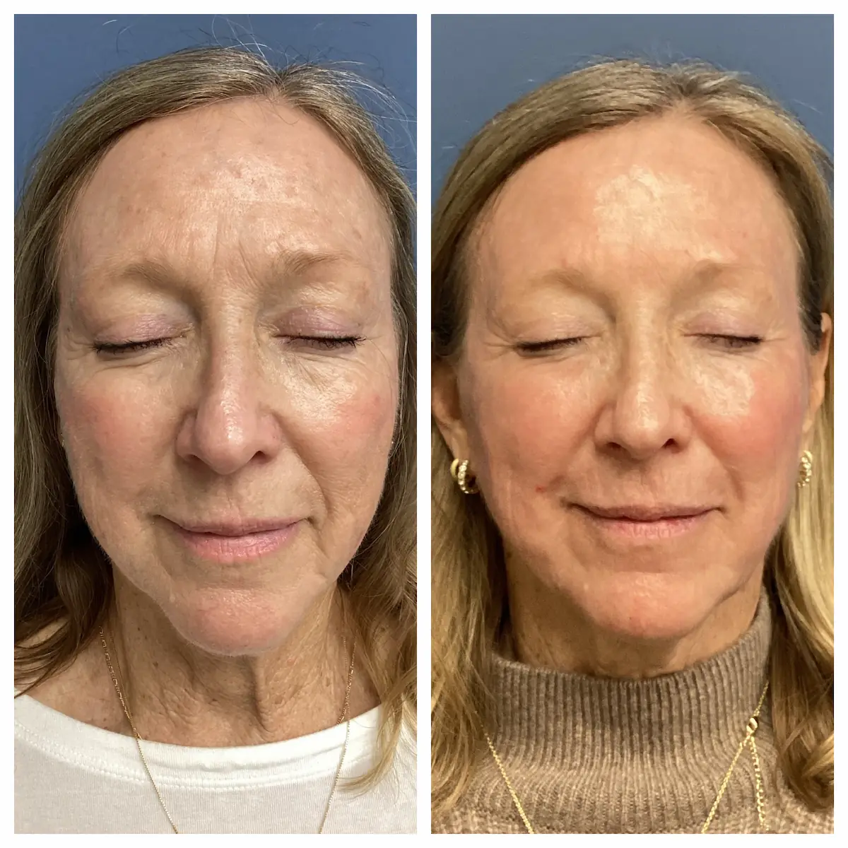 Full-face CO2 laser resurfacing before and after, front view — St. Louis Dermatology & Cosmetic Surgery