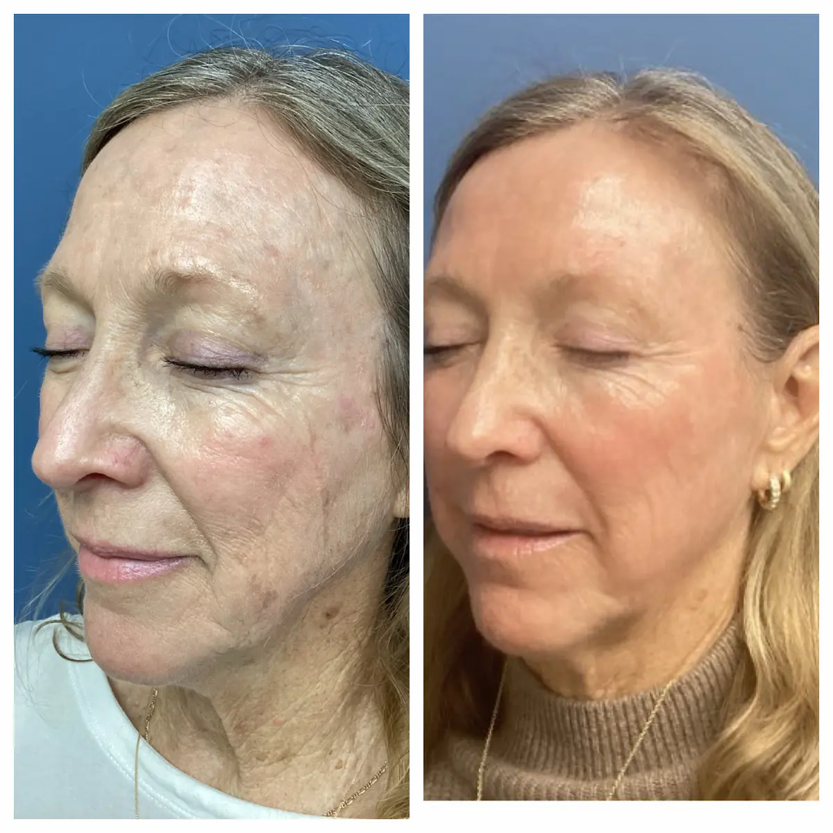 Full-face CO2 laser resurfacing before and after, oblique view — St. Louis Dermatology & Cosmetic Surgery