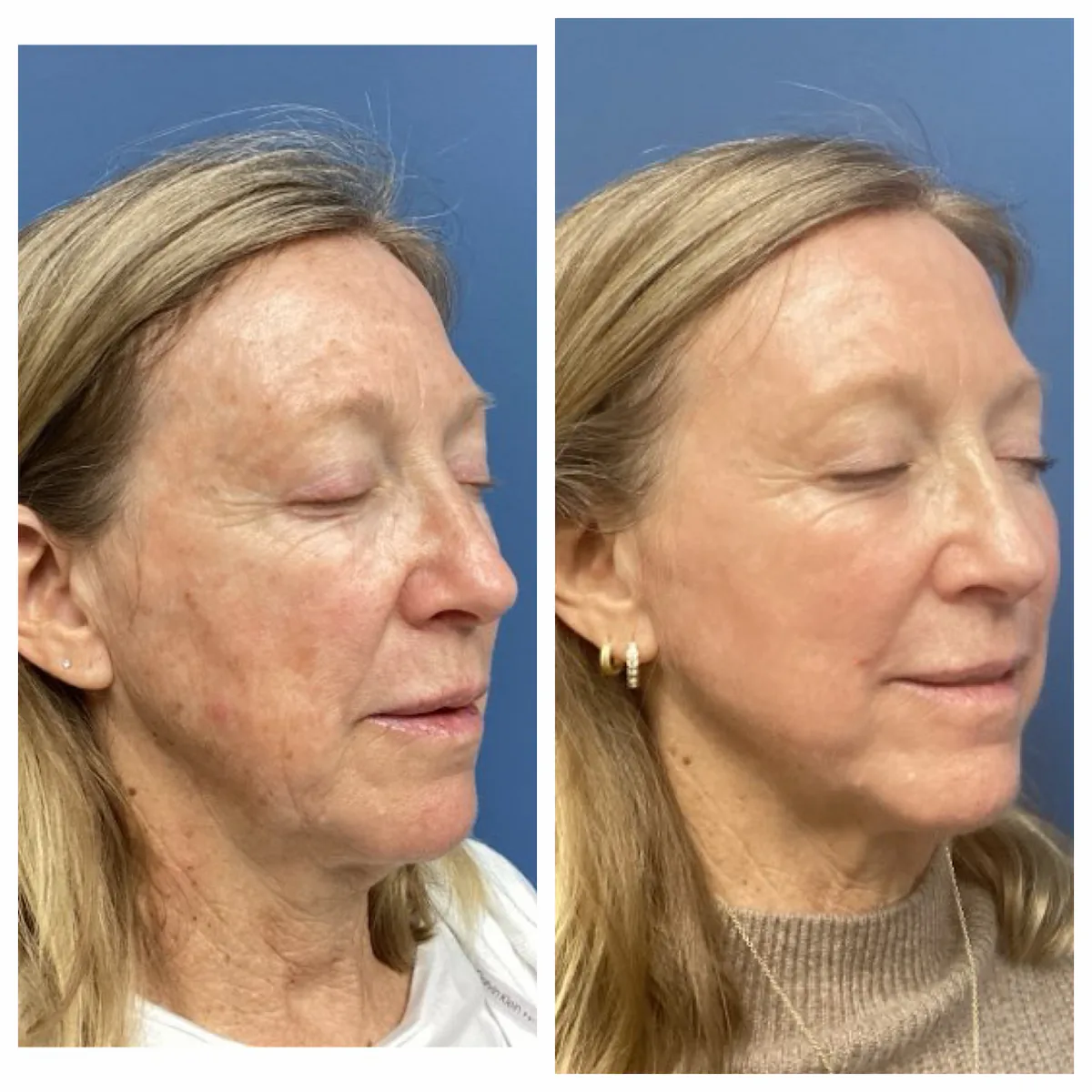 CO2 laser resurfacing before and after, profile view, patient of Dr. Brandon T. Beal