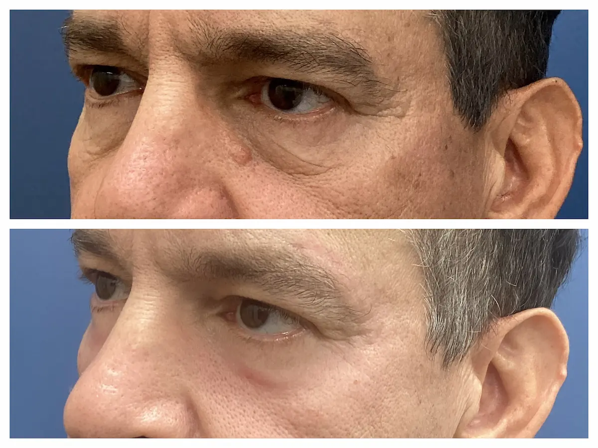 CO2 laser resurfacing before and after around the eyes, patient of Dr. Brandon T. Beal