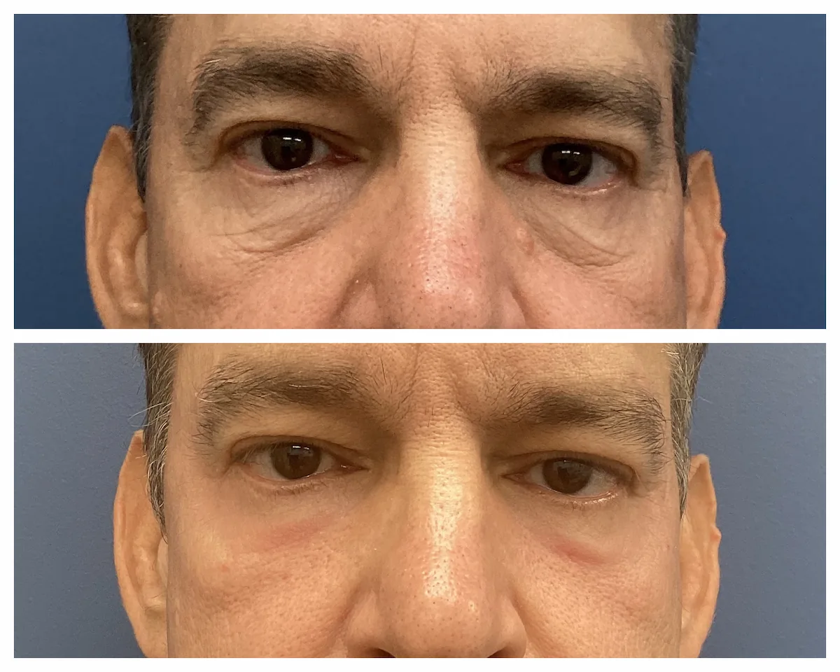 CO2 laser resurfacing before and after around the eyes, patient of Dr. Brandon T. Beal