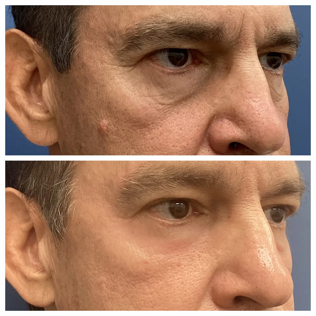 Under-eye CO2 laser resurfacing before and after, oblique view — St. Louis Dermatology & Cosmetic Surgery