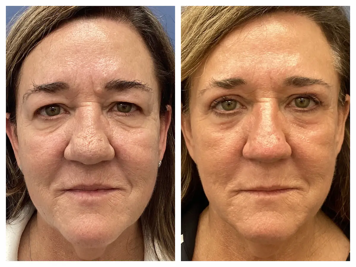 Rhinophyma with eyelid lift and CO2 laser before and after, view one — St. Louis Dermatology & Cosmetic Surgery