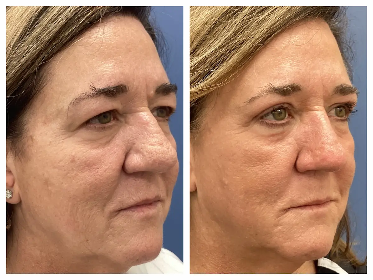 Rhinophyma with eyelid lift and CO2 laser before and after, view three — St. Louis Dermatology & Cosmetic Surgery