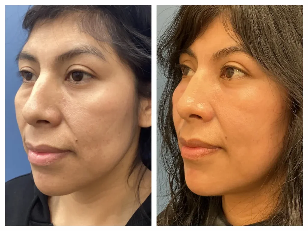 Lower eyelid blepharoplasty before and after, patient of Dr. Brandon T. Beal