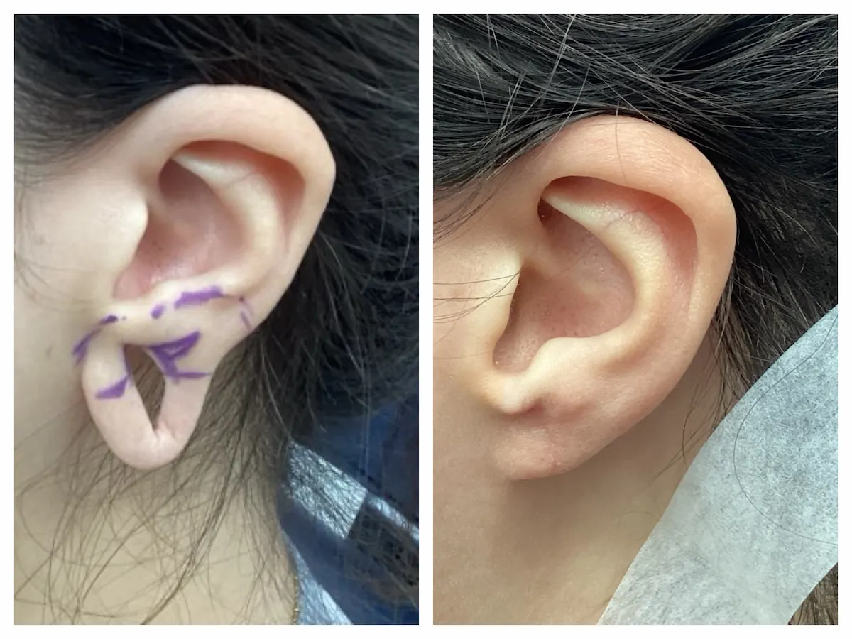 Gauged earlobe repair before and after, left ear — St. Louis Dermatology & Cosmetic Surgery