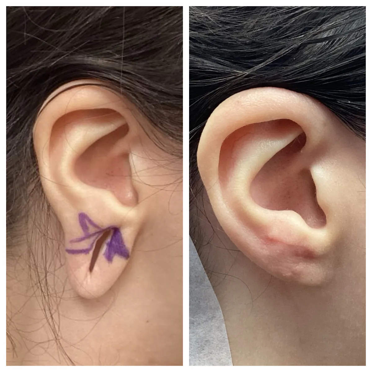 Gauged earlobe repair before and after, right ear — St. Louis Dermatology & Cosmetic Surgery