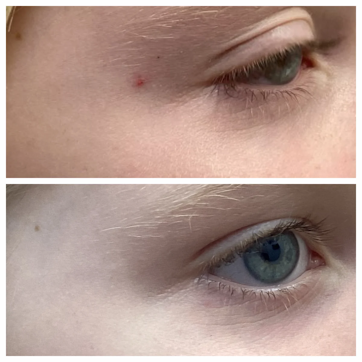 IPL for cherry angioma near the eye before and after — St. Louis Dermatology & Cosmetic Surgery
