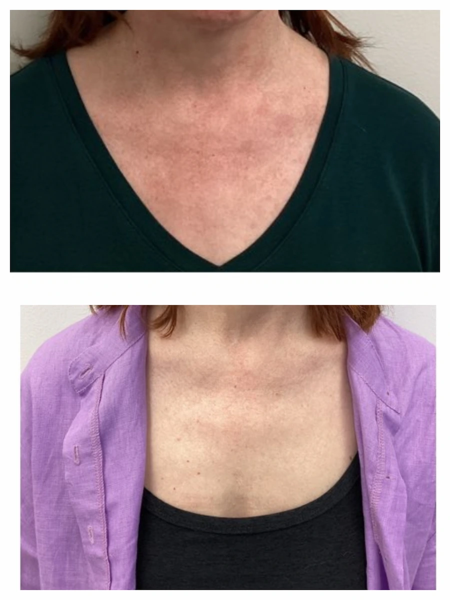 IPL for chest and decolletage redness and sun damage before and after — St. Louis Dermatology & Cosmetic Surgery