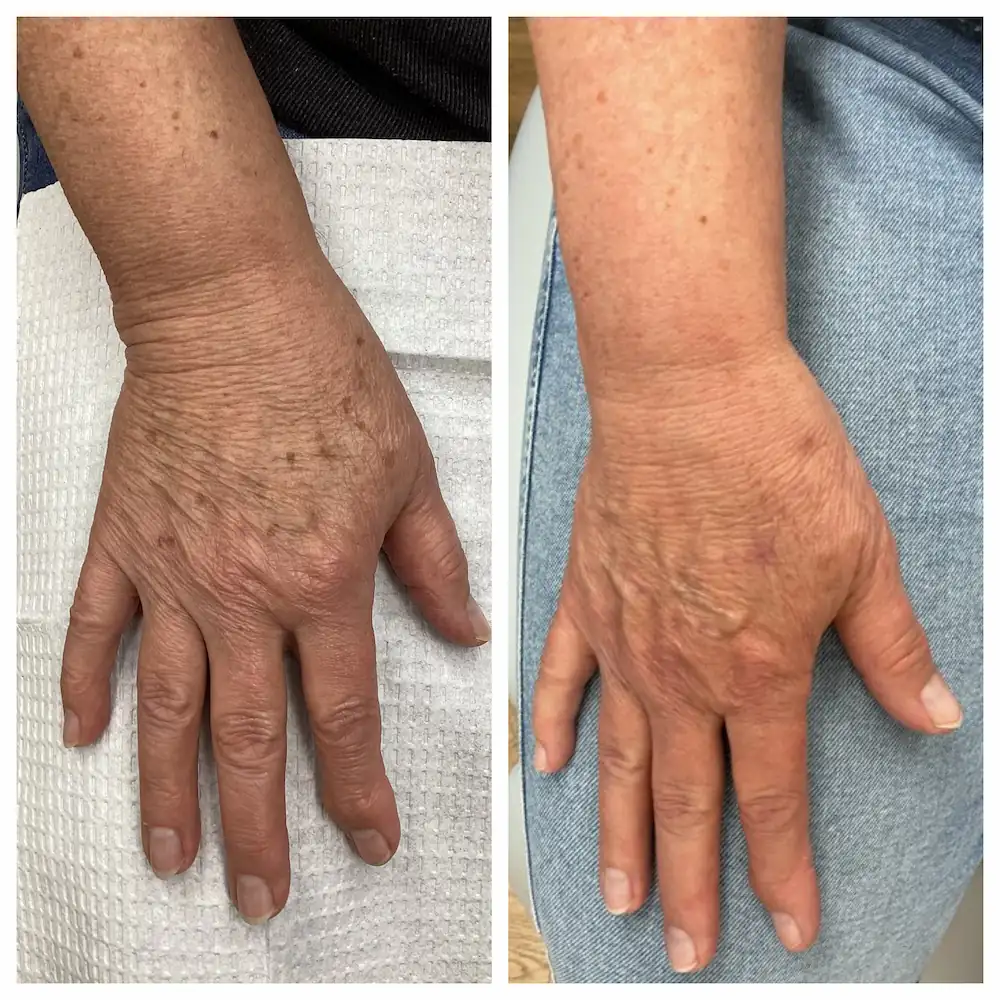 IPL for sun spots on the hands before and after — St. Louis Dermatology & Cosmetic Surgery