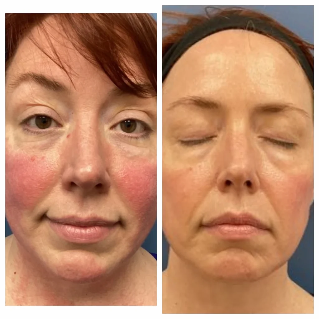ipl_rosacea_before_and_after-x1 (2)