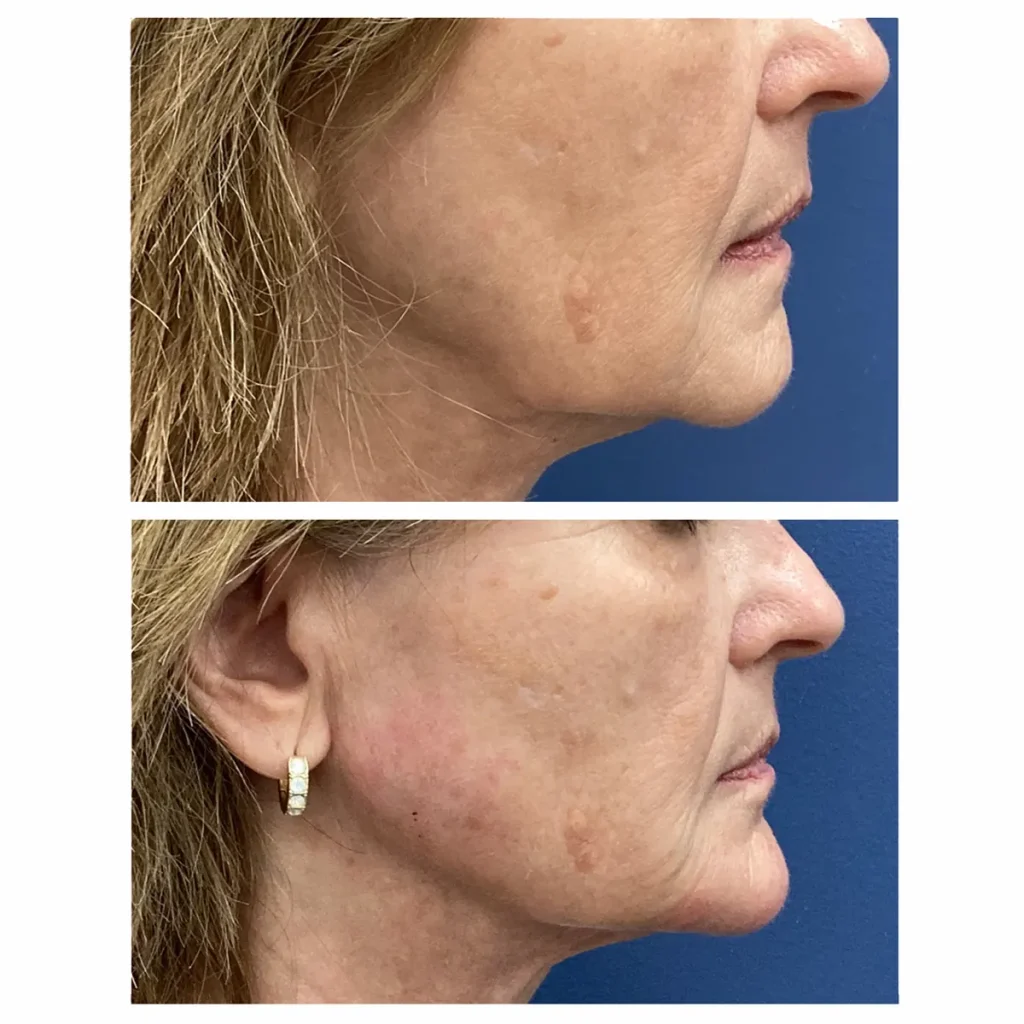 Dermal filler before and after restoring lower-face volume, patient of Dr. Brandon T. Beal