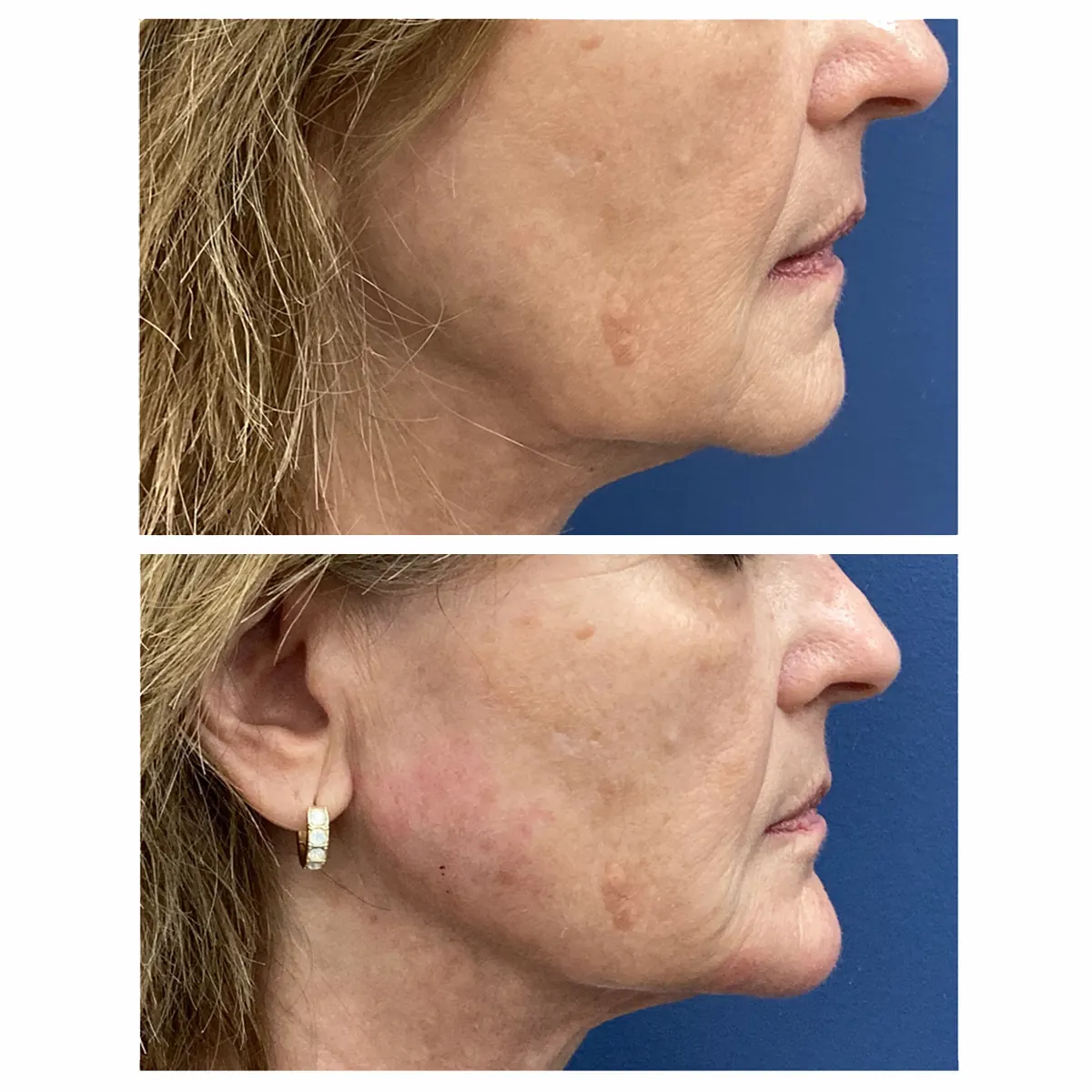 Jawline filler before and after — St. Louis Dermatology & Cosmetic Surgery