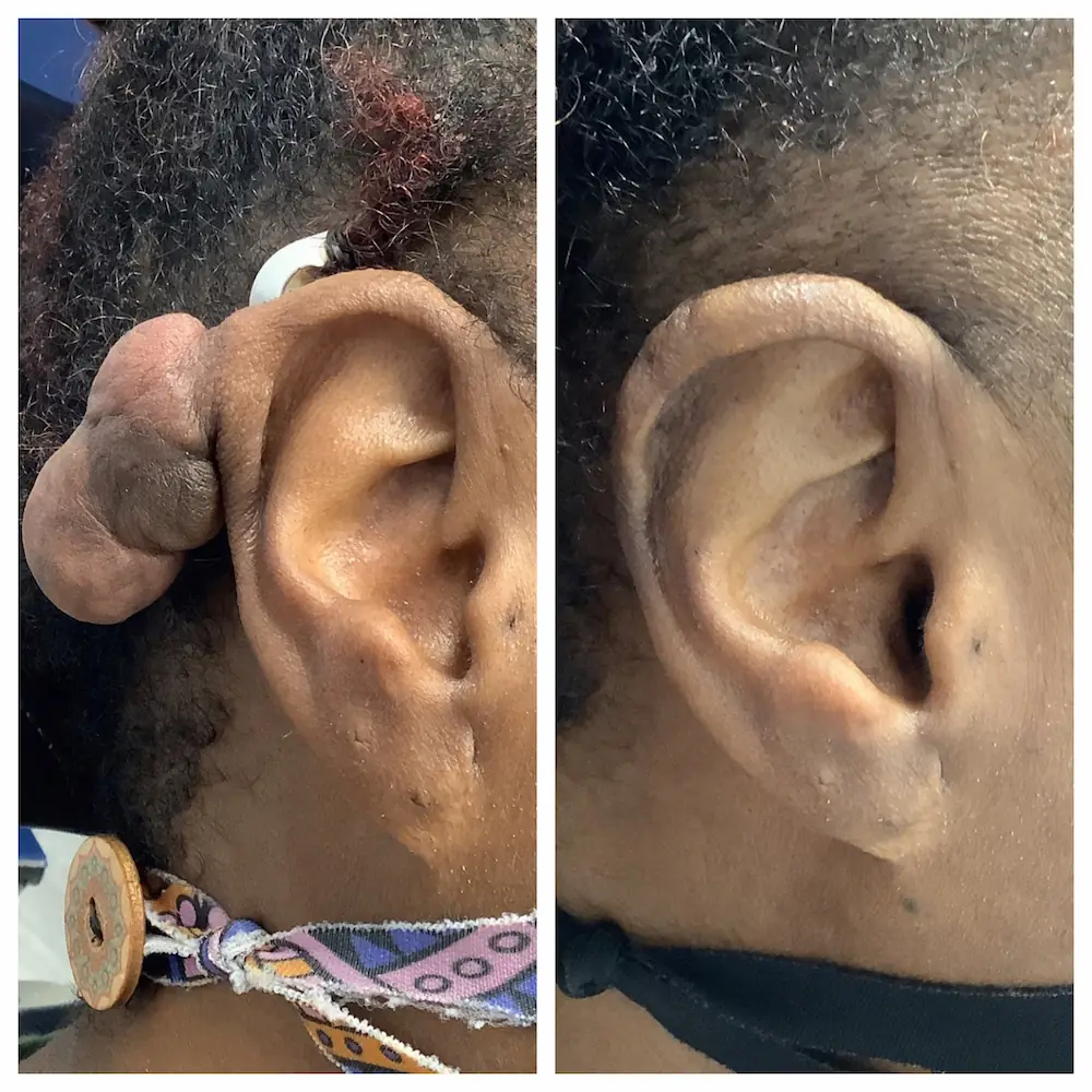 Keloid treatment before and after on the ear, patient of Dr. Brandon T. Beal