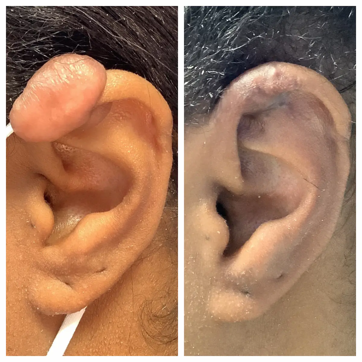 Ear keloid removal before and after, second view — St. Louis Dermatology & Cosmetic Surgery