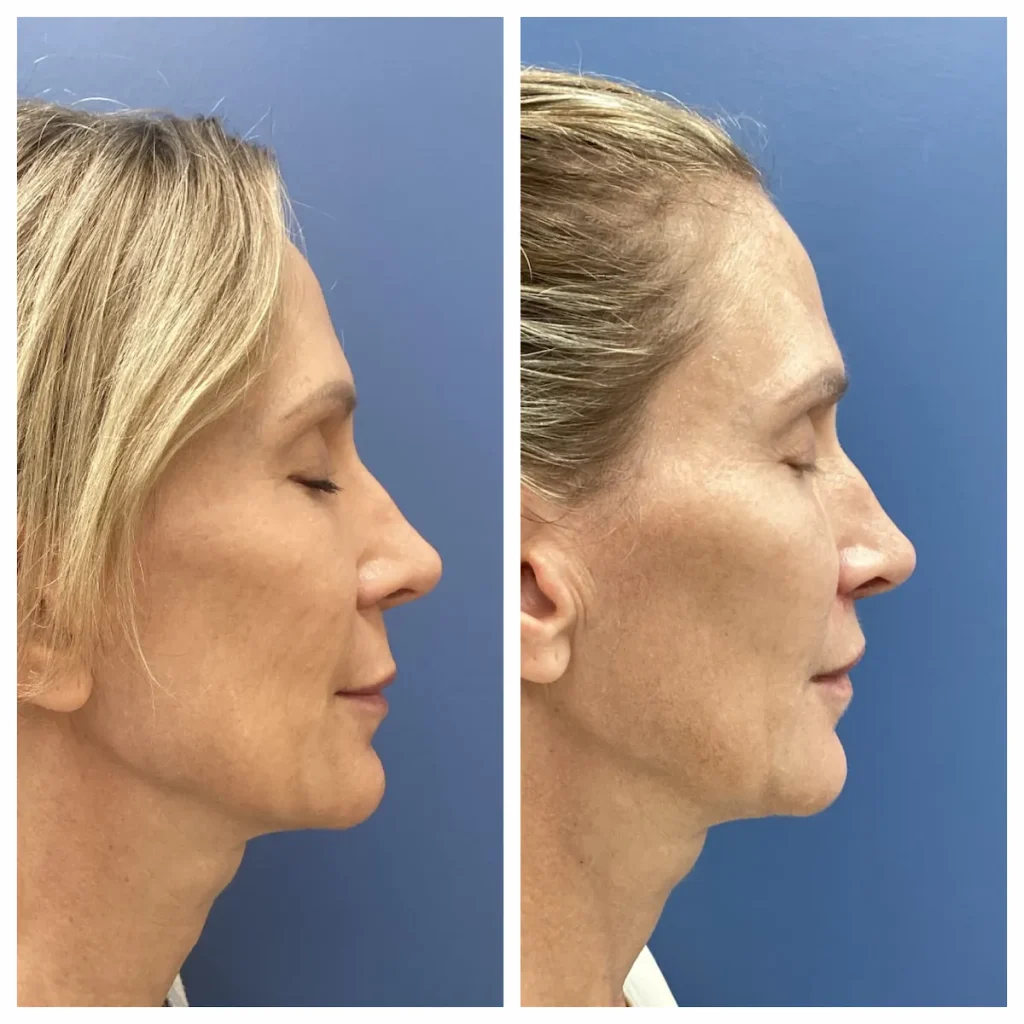 Facelift before and after, patient of Dr. Brandon T. Beal