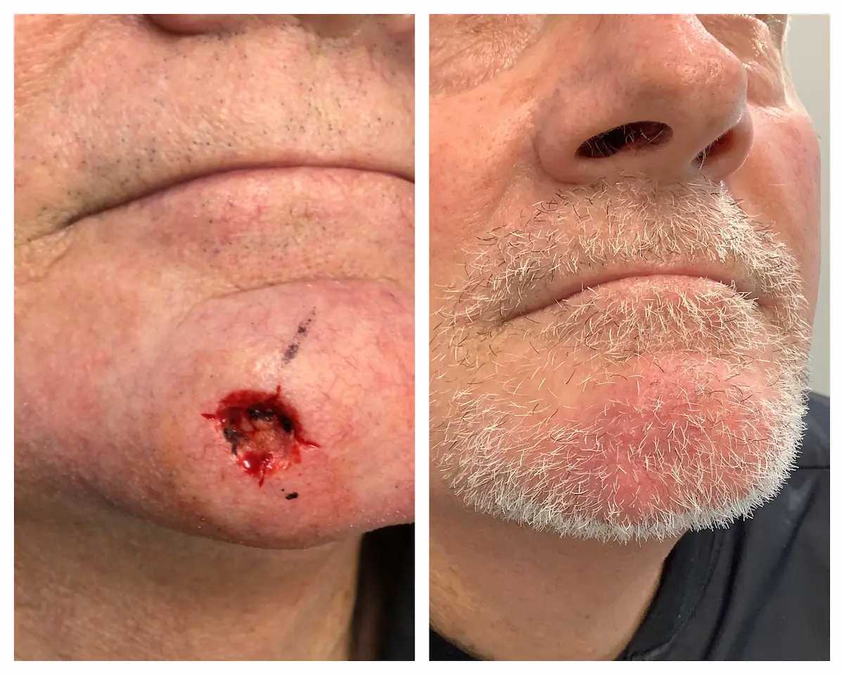 Chin Mohs surgery and reconstruction, before and after — St. Louis Dermatology & Cosmetic Surgery