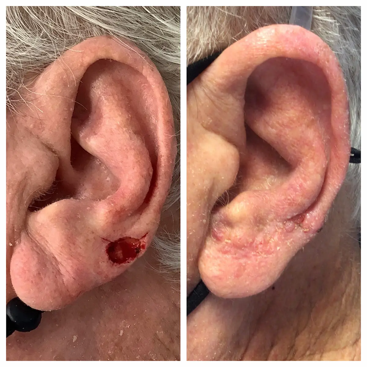 Ear Mohs surgery and reconstruction, before and after — St. Louis Dermatology & Cosmetic Surgery
