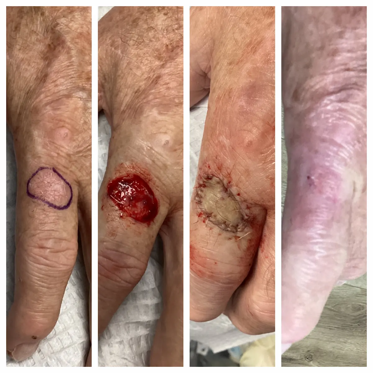 Finger squamous cell carcinoma Mohs surgery and reconstruction — St. Louis Dermatology & Cosmetic Surgery