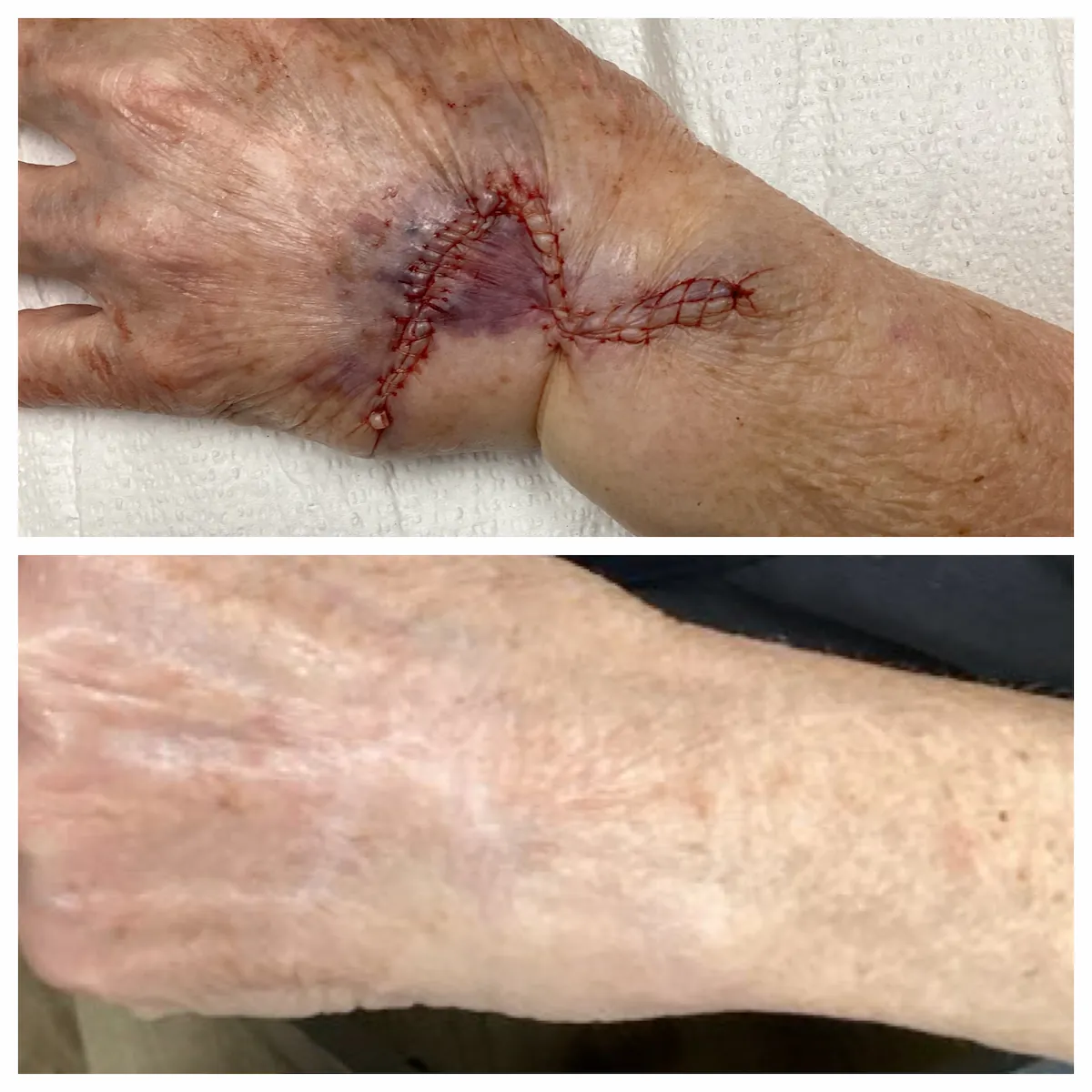 Hand Mohs surgery and reconstruction, before and after — St. Louis Dermatology & Cosmetic Surgery