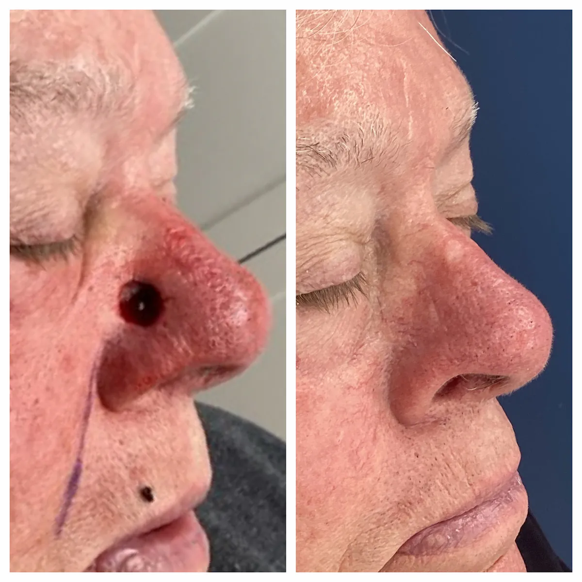 Nose Mohs surgery and reconstruction, immediate post-op — St. Louis Dermatology & Cosmetic Surgery
