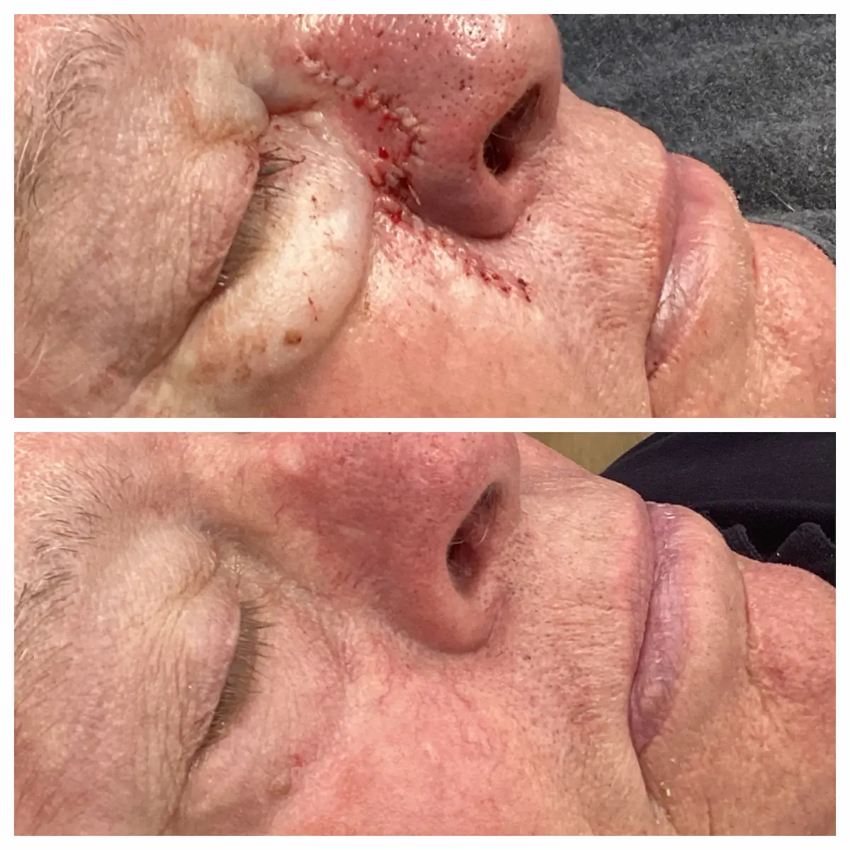 Nose Mohs surgery and reconstruction, immediate post-op — St. Louis Dermatology & Cosmetic Surgery