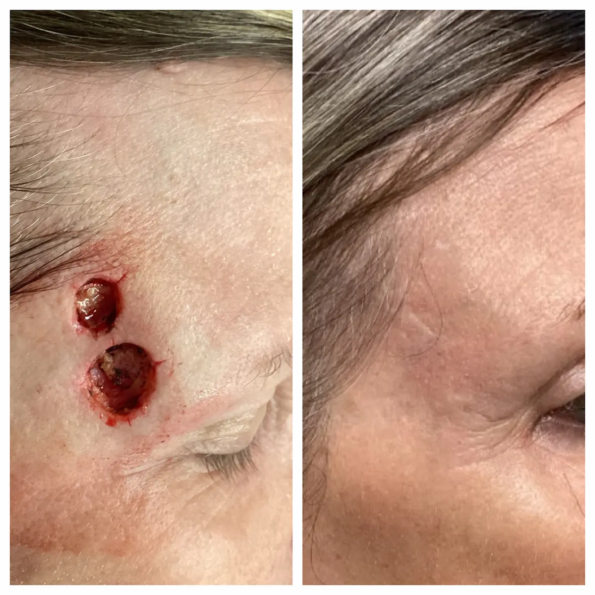 Temple Mohs surgery and reconstruction, before and after — St. Louis Dermatology & Cosmetic Surgery