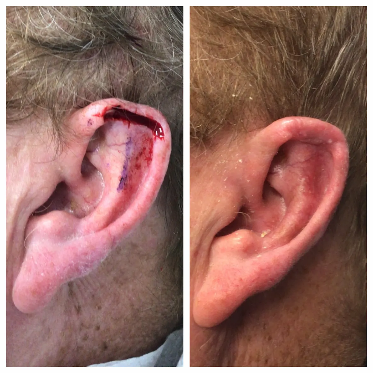 Ear Mohs surgery with skin graft reconstruction, before and after — St. Louis Dermatology & Cosmetic Surgery
