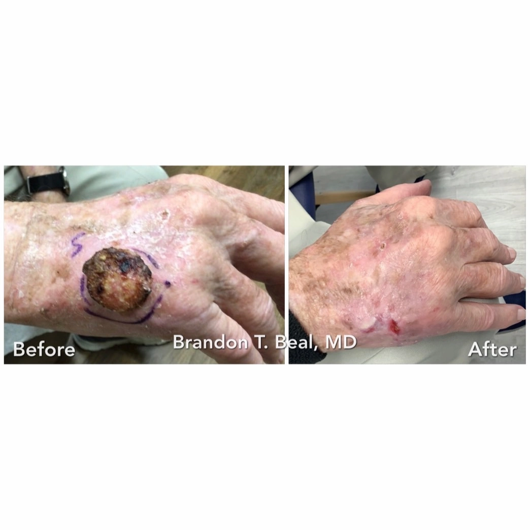 Hand squamous cell carcinoma Mohs surgery and reconstruction, before and after — St. Louis Dermatology & Cosmetic Surgery