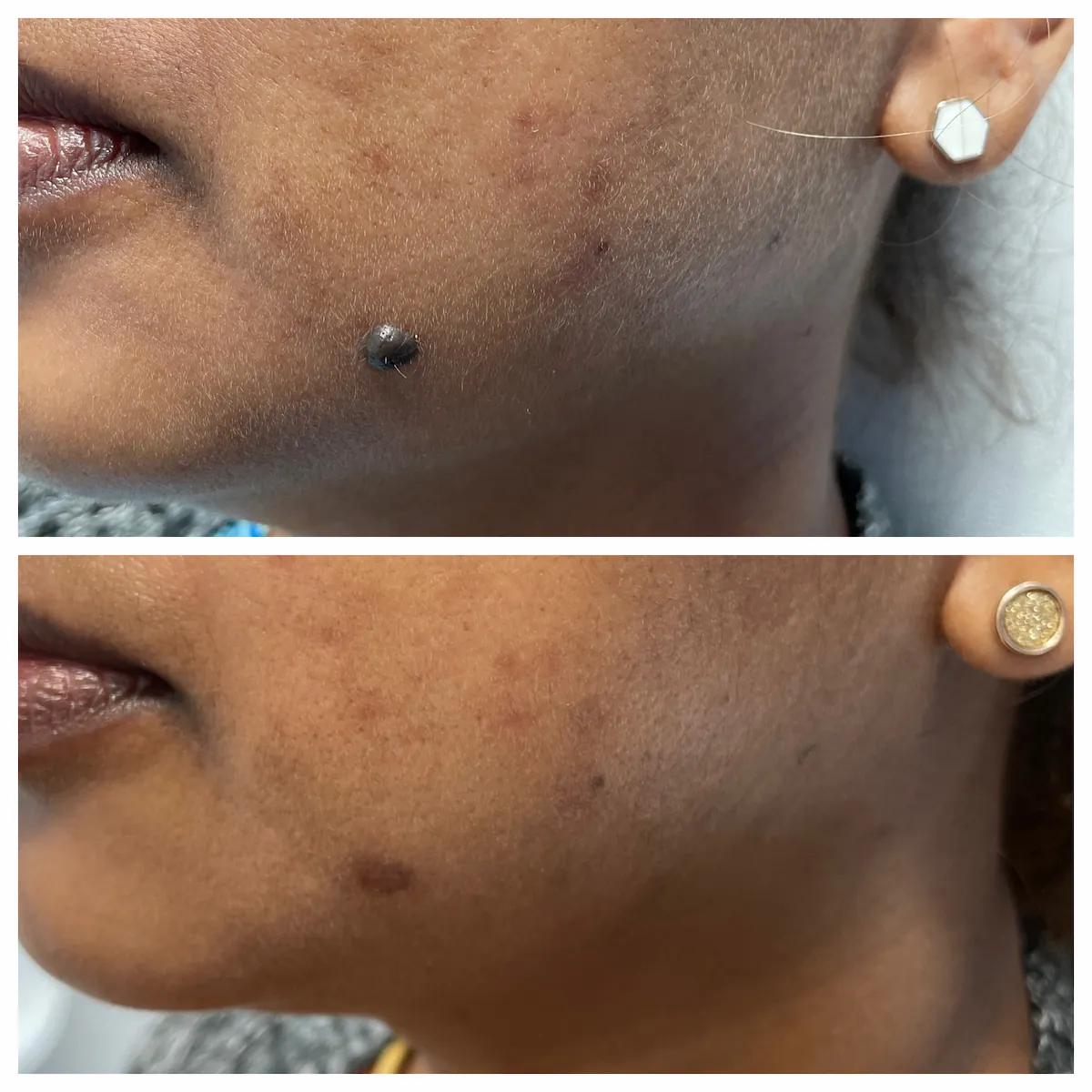 Chin and jawline mole removal before and after — St. Louis Dermatology & Cosmetic Surgery
