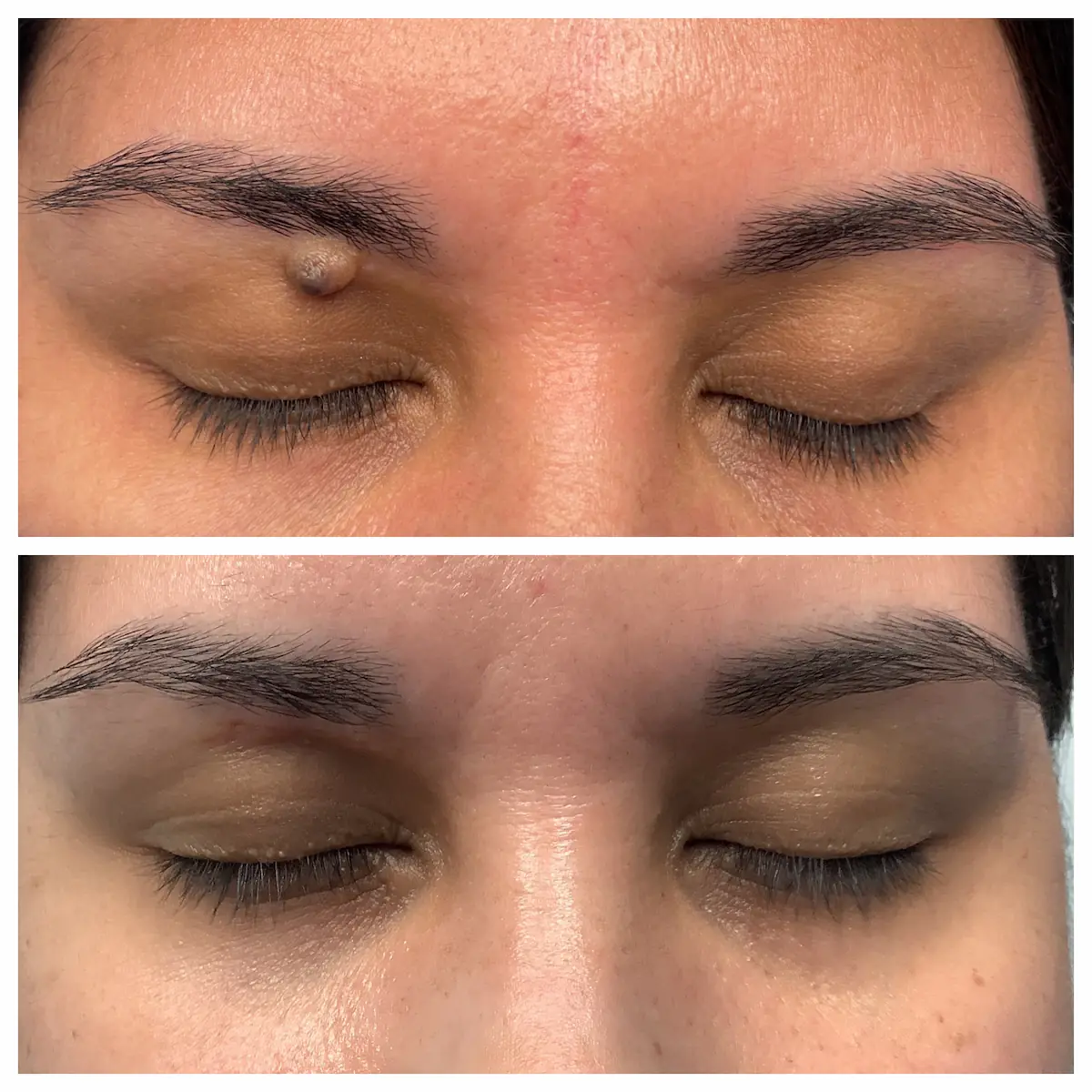 Brow and upper eyelid mole removal before and after — St. Louis Dermatology & Cosmetic Surgery