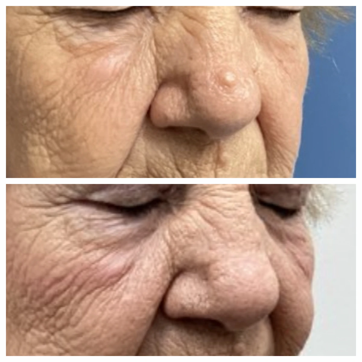 Nasal mole removal before and after — St. Louis Dermatology & Cosmetic Surgery