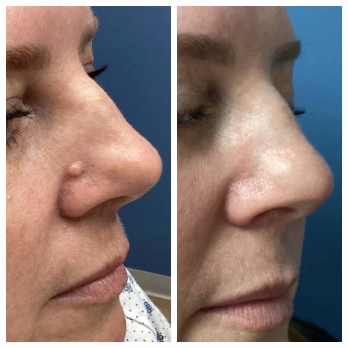 Nose mole removal before and after — St. Louis Dermatology & Cosmetic Surgery