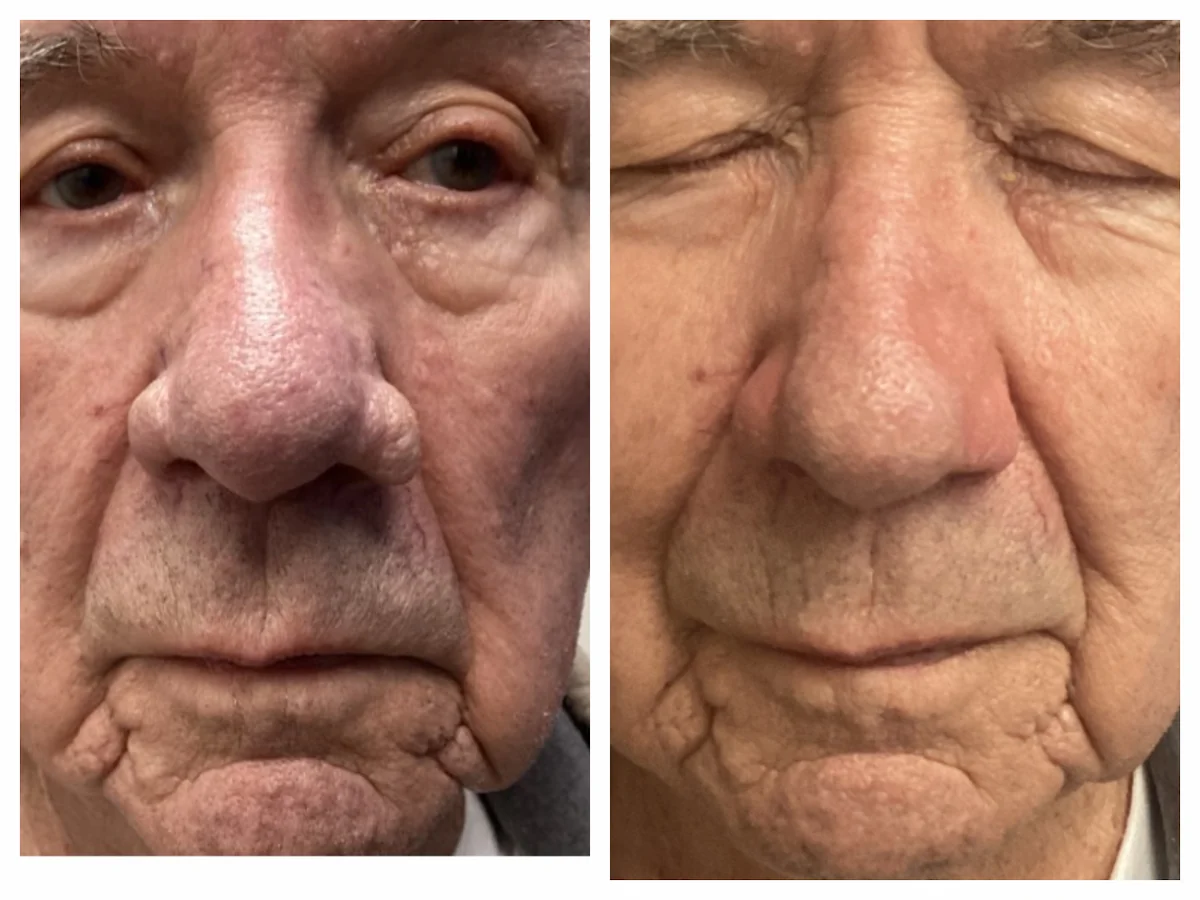 Rhinophyma surgical recontouring of the nose, before and after, oblique view — St. Louis Dermatology & Cosmetic Surgery