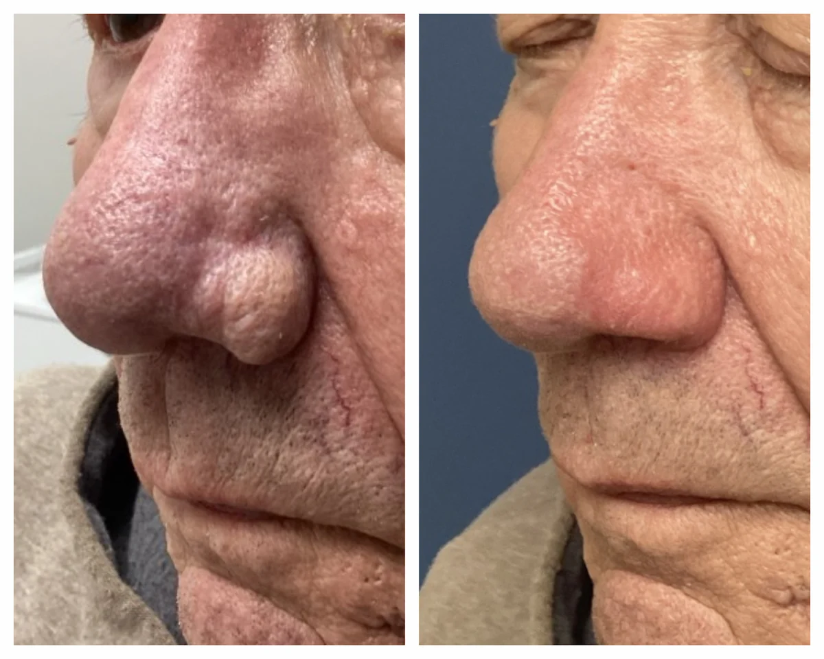 Rhinophyma surgery before and after, oblique view — St. Louis Dermatology & Cosmetic Surgery