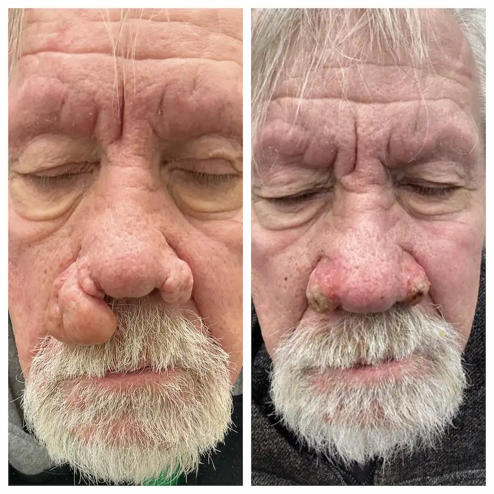 Rhinophyma surgical recontouring of the nose, before and after — St. Louis Dermatology & Cosmetic Surgery