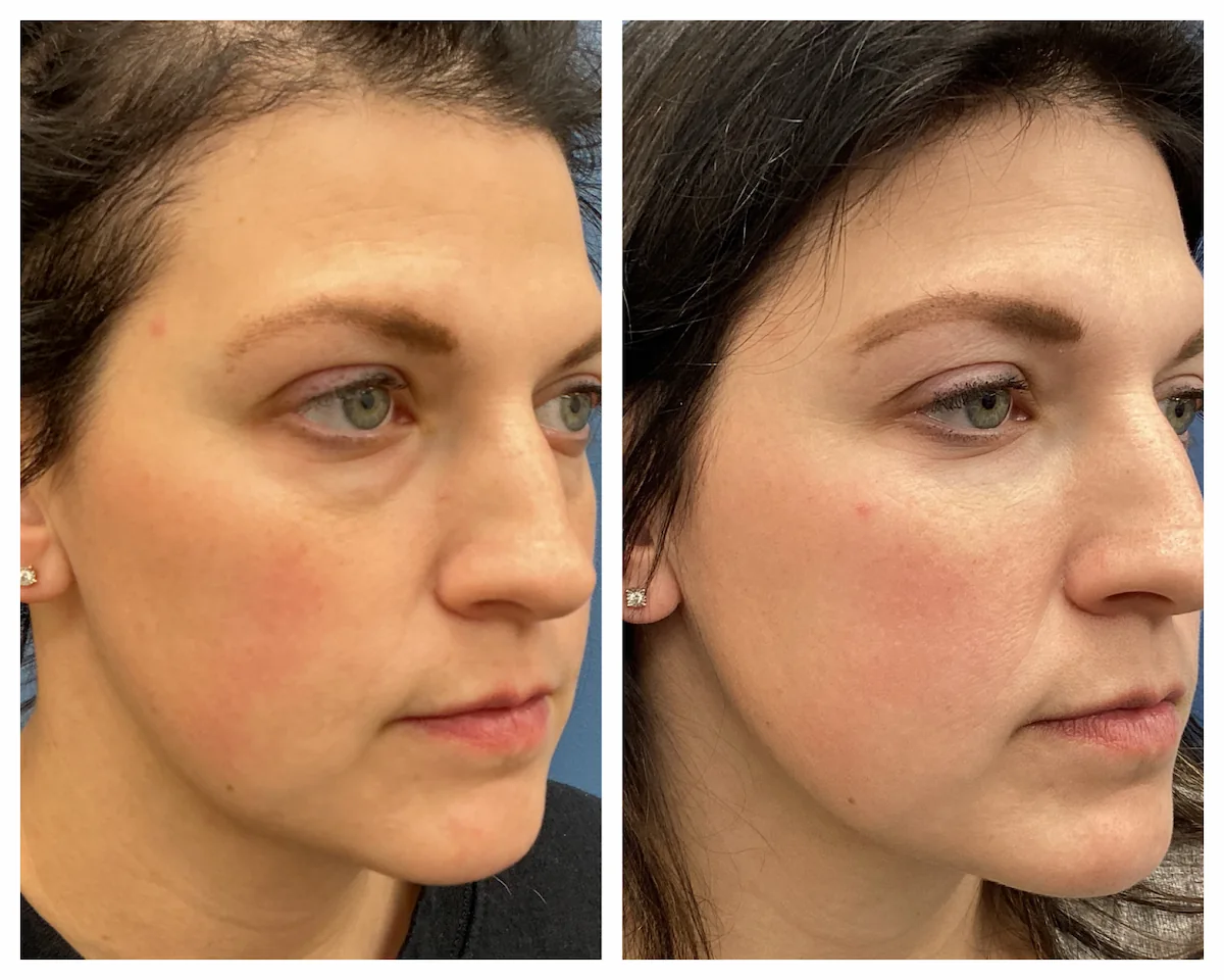 Tear trough under-eye filler before and after — St. Louis Dermatology & Cosmetic Surgery