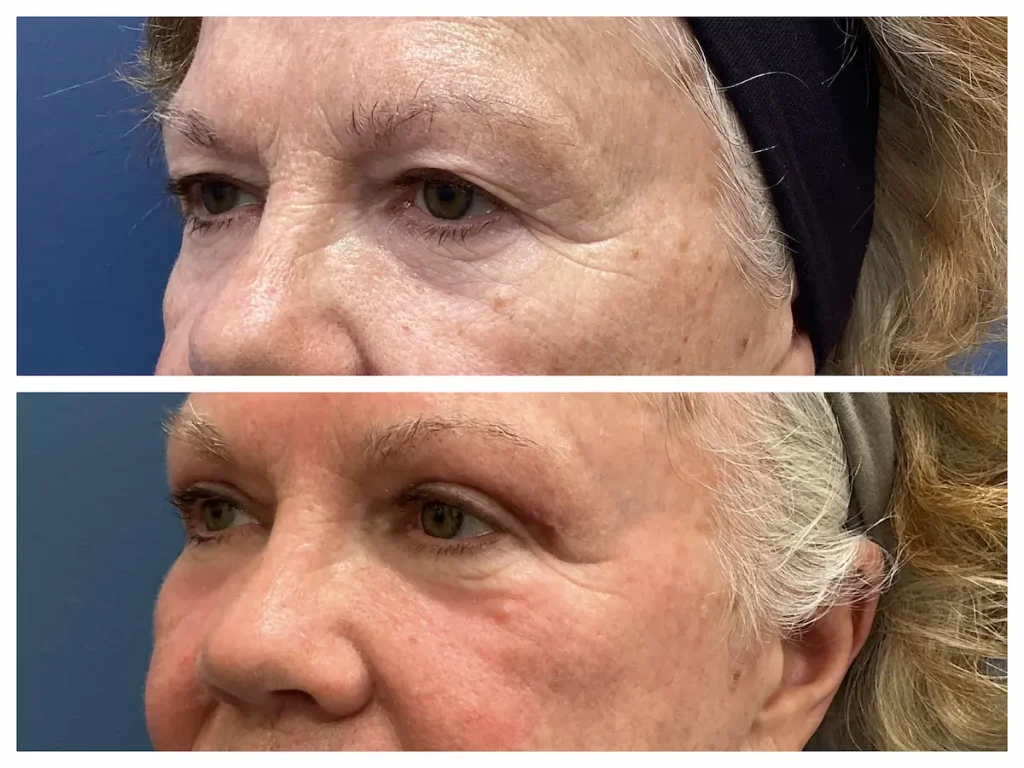 Upper eyelid blepharoplasty before and after, patient of Dr. Brandon T. Beal