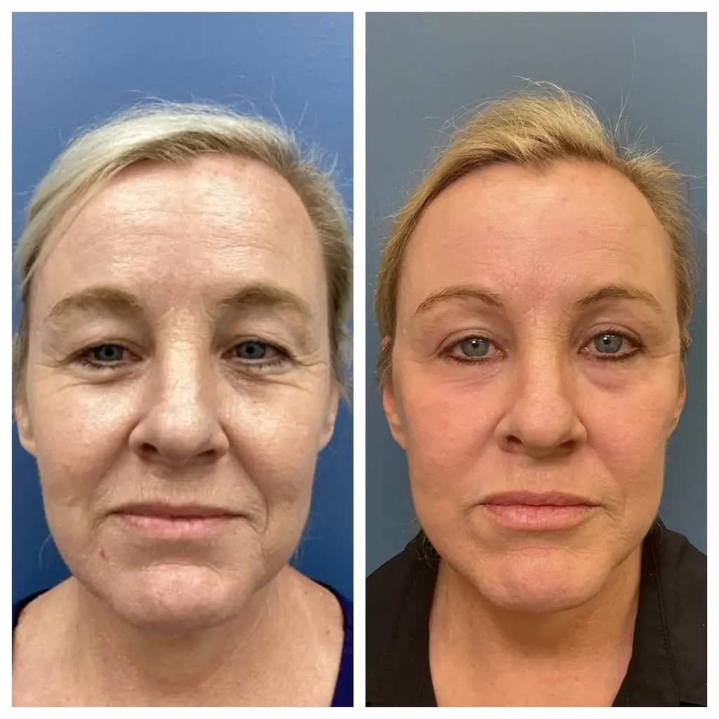Face and neck lift before and after, front view, patient of Dr. Brandon T. Beal