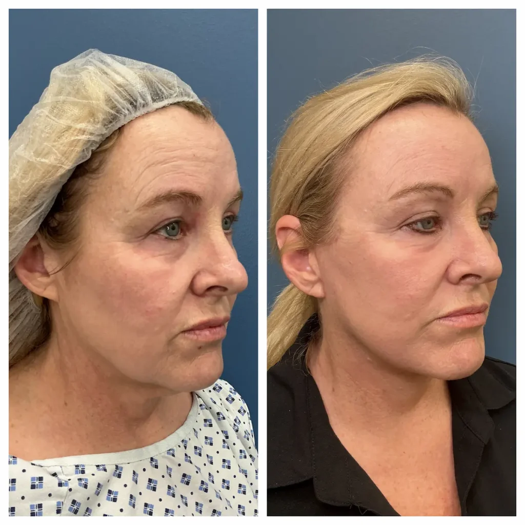 Face and neck lift before and after, right oblique view — St. Louis Dermatology & Cosmetic Surgery