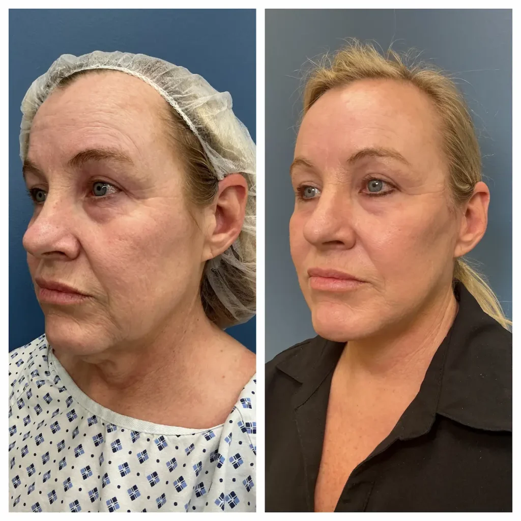 Face and neck lift before and after, oblique view, patient of Dr. Brandon T. Beal
