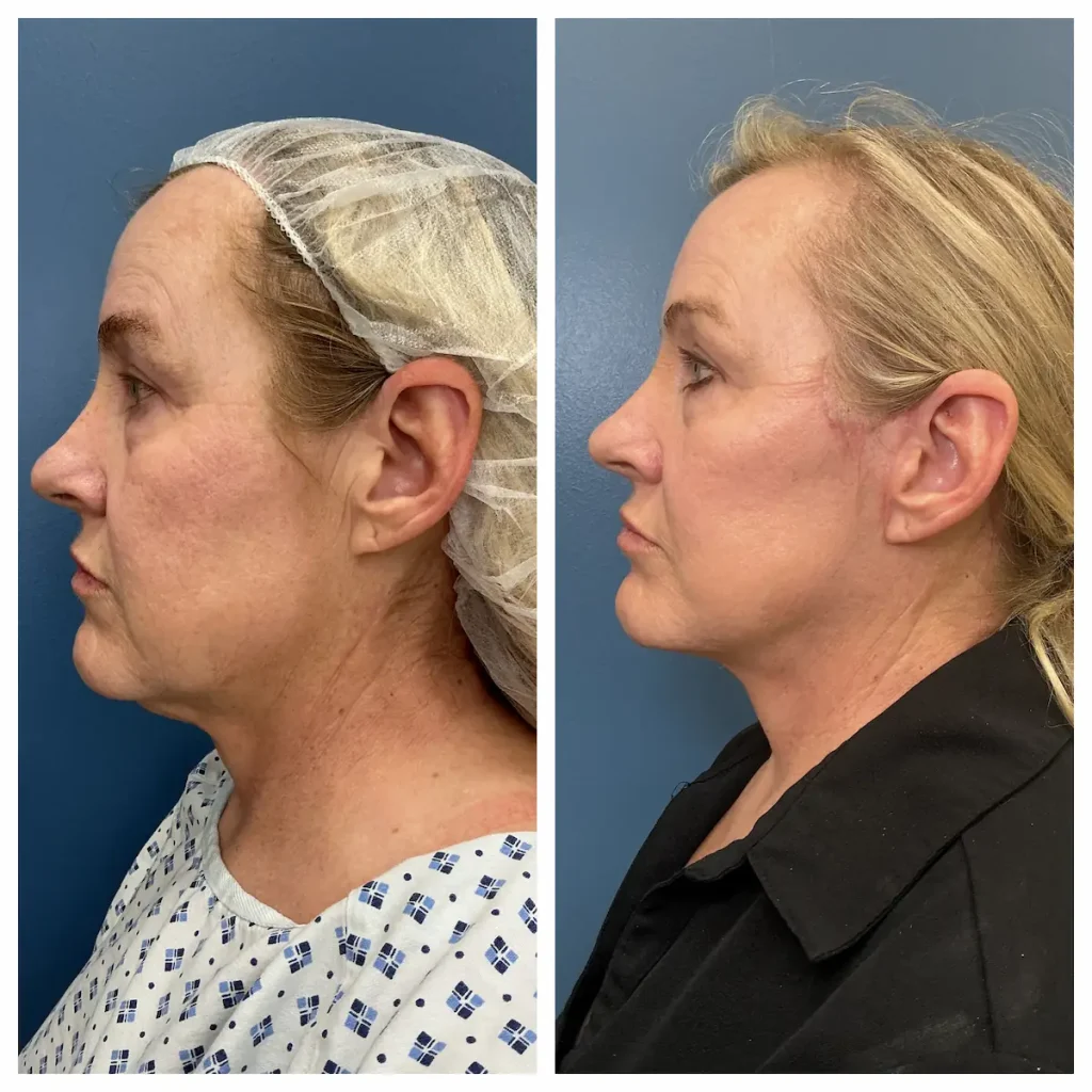 Face and neck lift before and after, profile view, patient of Dr. Brandon T. Beal