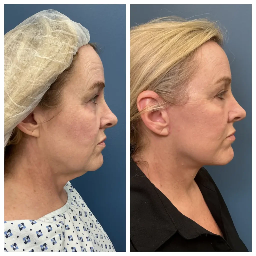 face-and-neck-lift-before-and-after (5)