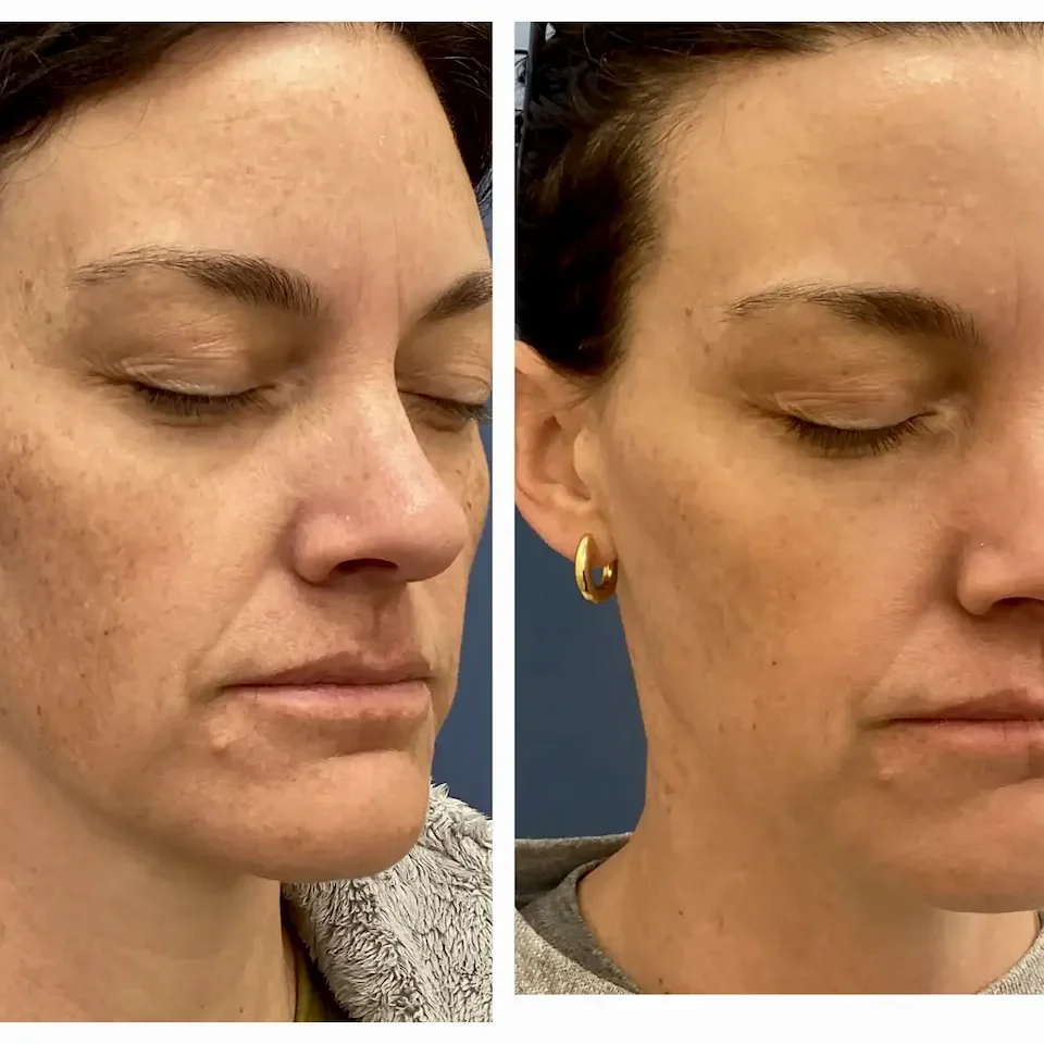 Laser for brown spots Sun Spots 1